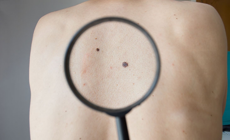 Sumnjivi madež na nečijim leđima pod povećalom. Izvor: cunaplus/Shutterstock.