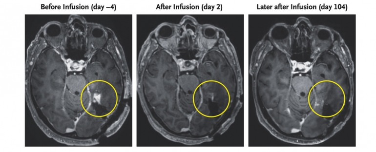 MRI snimka 72-godišnjeg pacijenta s glioblastomom. (Choi i sur., NEMJ, 2024.)