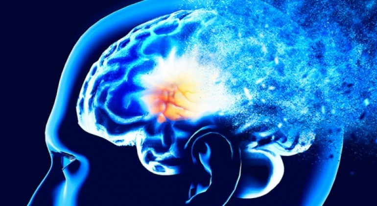 Model strojnog učenja procjenjivao rizik Alzheimerove bolesti godinama prije dijagnoze